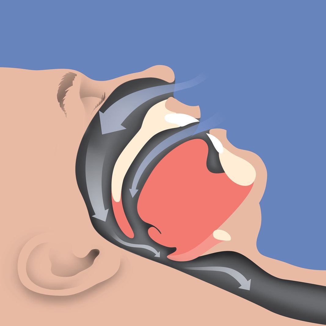 narrow breathing way due to apnea