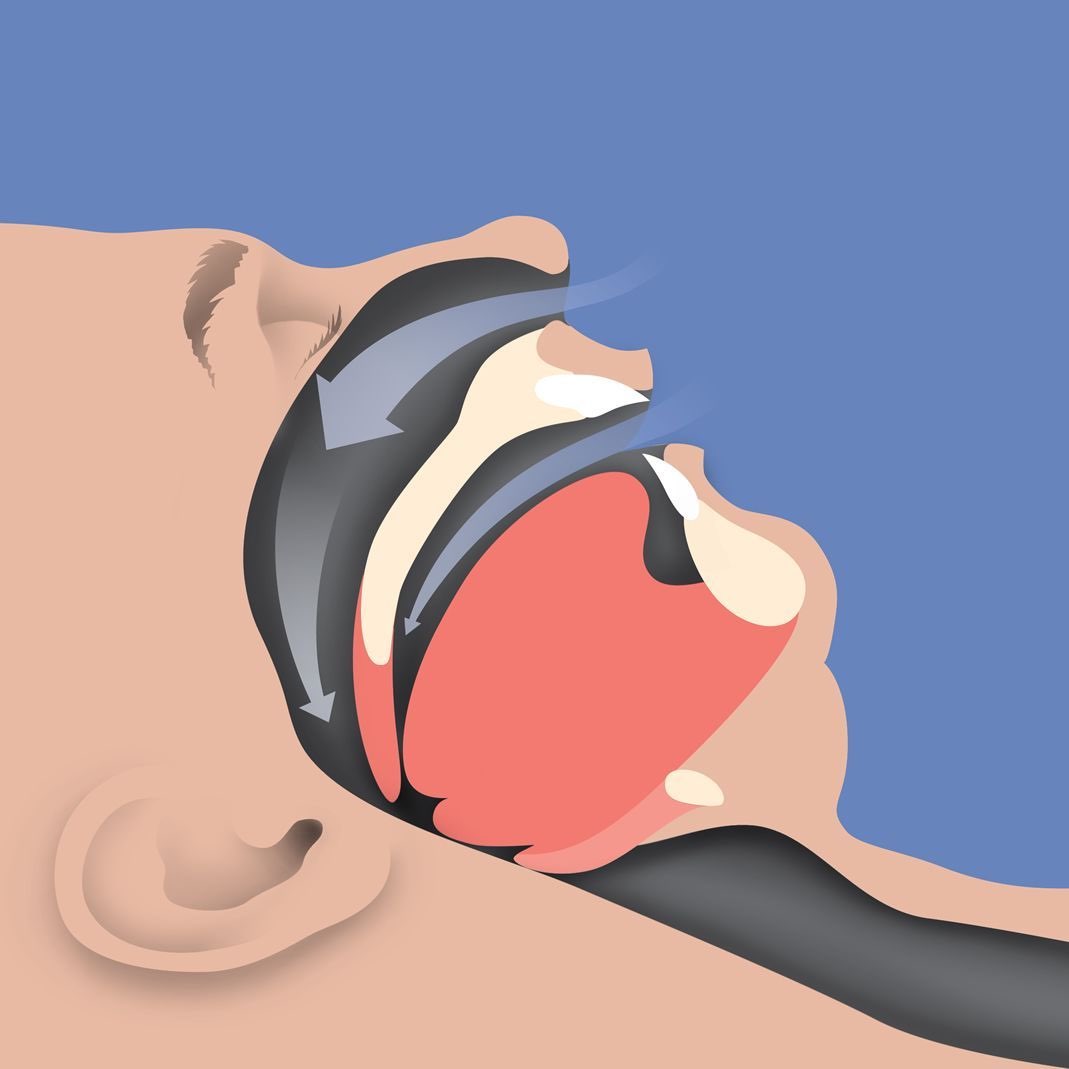 closed breathing way due to apnea