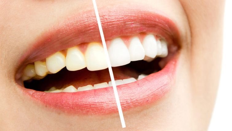 teeth whitening
