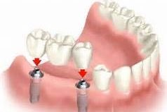 implant bridges