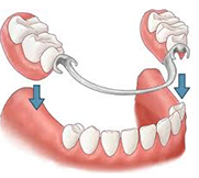 partial denture
